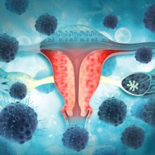 virus or bacteria infected female reproductive system, Uterine diseases concept, uterus cancer, 3d illustration